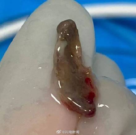 5岁娃咳嗽1年没好！发现肺里藏鸡骨头