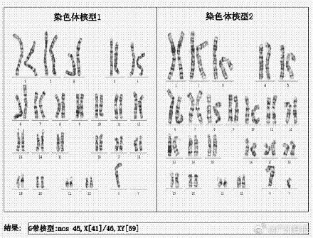 13岁女孩闭经两年查出男性染色体  医生：嵌合型特纳综合征，极其罕见！