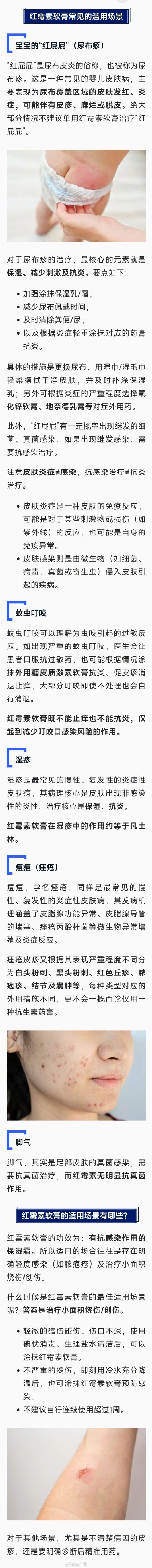 别再这样乱用红霉素软膏了 别再这样乱用红霉素软膏了