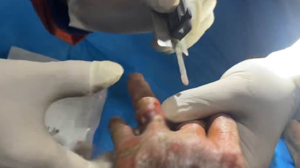 老人中毒被急送医院,手上的它却成救治“拦路虎” 老人中毒被急送医院,手上的它却成救治“拦路虎”