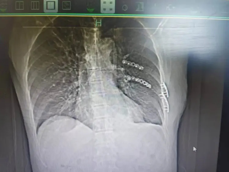 因一个动作,浙江男子在家摔断13根骨头!这些行为很危险 因一个动作,浙江男子在家摔断13根骨头!这些行为很危险