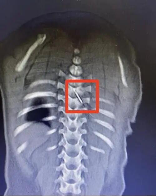 3厘米缝衣针“钻”进婴儿脊柱!合肥医生紧急救治 3厘米缝衣针“钻”进婴儿脊柱!合肥医生紧急救治