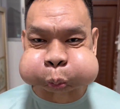 广东一男子吹玻璃30年致腮帮变形,调侃自己是“青蛙王子”会蛤蟆功 广东一男子吹玻璃30年致腮帮变形,调侃自己是“青蛙王子”会蛤蟆功