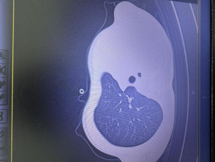 早上发烧,晚上就“白肺”还堵满“痰栓”!这4个重症前兆要留意→ 早上发烧,晚上就“白肺”还堵满“痰栓”!这4个重症前兆要留意→