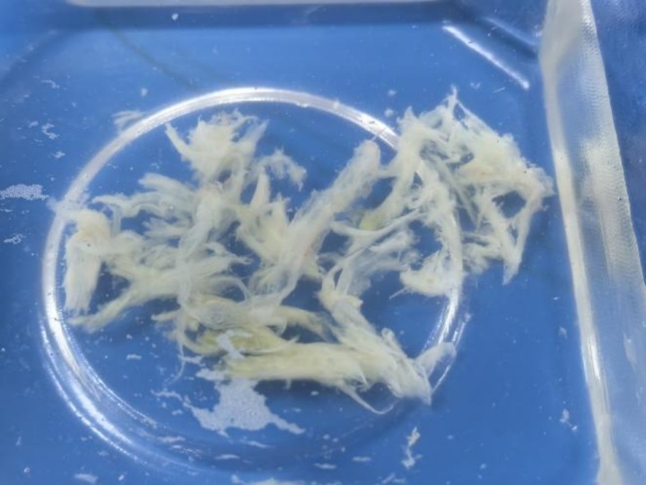 早上发烧,晚上就“白肺”还堵满“痰栓”!这4个重症前兆要留意→ 早上发烧,晚上就“白肺”还堵满“痰栓”!这4个重症前兆要留意→