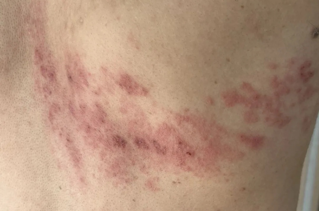 每年冬天杭州都有不少人中招,剧痛难忍......尽早去正规医院! 每年冬天杭州都有不少人中招,剧痛难忍......尽早去正规医院!