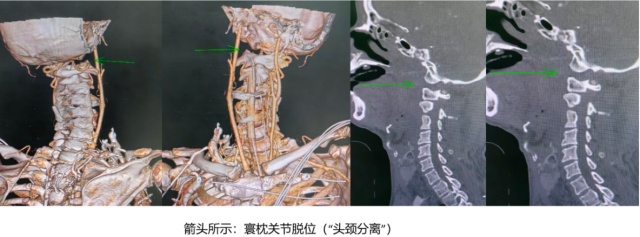 惊心动魄!60岁老人因意外“头颈分离”直送ICU 惊心动魄!60岁老人因意外“头颈分离”直送ICU