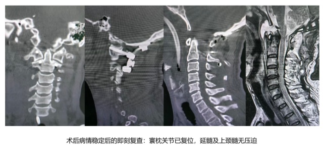 惊心动魄!60岁老人因意外“头颈分离”直送ICU 惊心动魄!60岁老人因意外“头颈分离”直送ICU