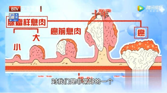 这种息肉几乎100%会癌变!40岁就该做检查了 这种息肉几乎100%会癌变!40岁就该做检查了