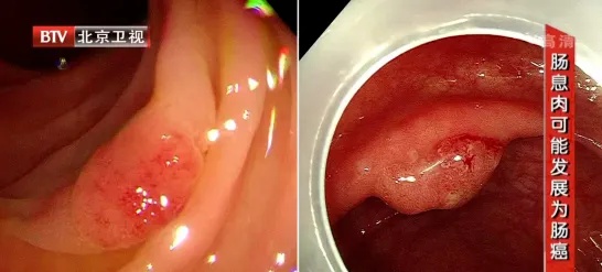 这种息肉几乎100%会癌变!40岁就该做检查了 这种息肉几乎100%会癌变!40岁就该做检查了