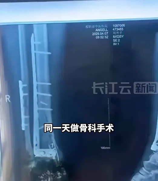 两人同病房同一天手术，接连出现钻头遗落体内，当地官方通报