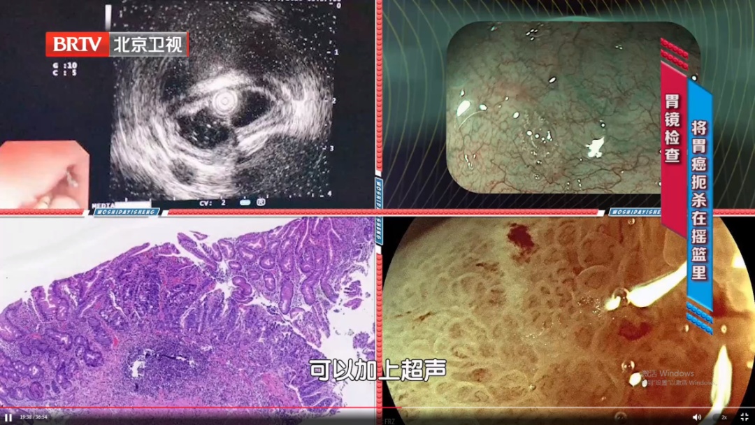 这种息肉几乎100%会癌变!40岁就该做检查了 这种息肉几乎100%会癌变!40岁就该做检查了