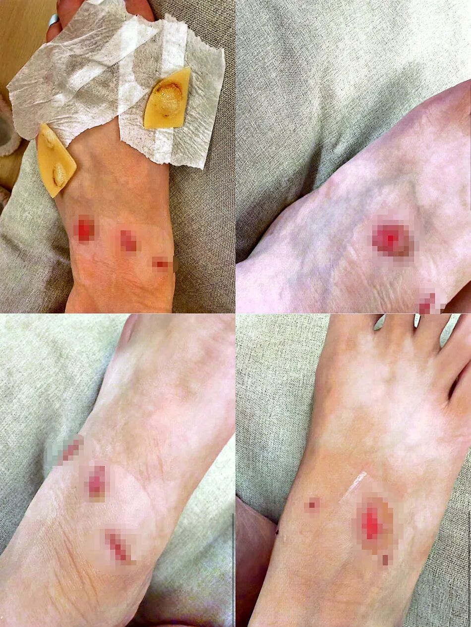 上海女子近万元购入大牌运动鞋，穿了十分钟后双脚破皮留疤需整形！客服：不能退