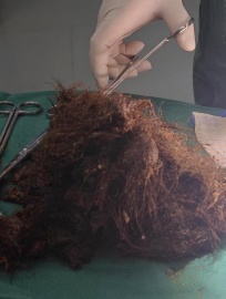 密密麻麻，杭州姑娘体内取出2斤！医生傻眼：你都25岁了...