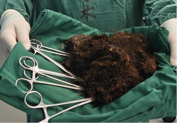 密密麻麻，杭州姑娘体内取出2斤！医生傻眼：你都25岁了...