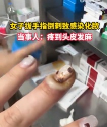 不要拔,很多人忍不住!男子不慎感染导致溃烂、刮骨疗毒 不要拔,很多人忍不住!男子不慎感染导致溃烂、刮骨疗毒