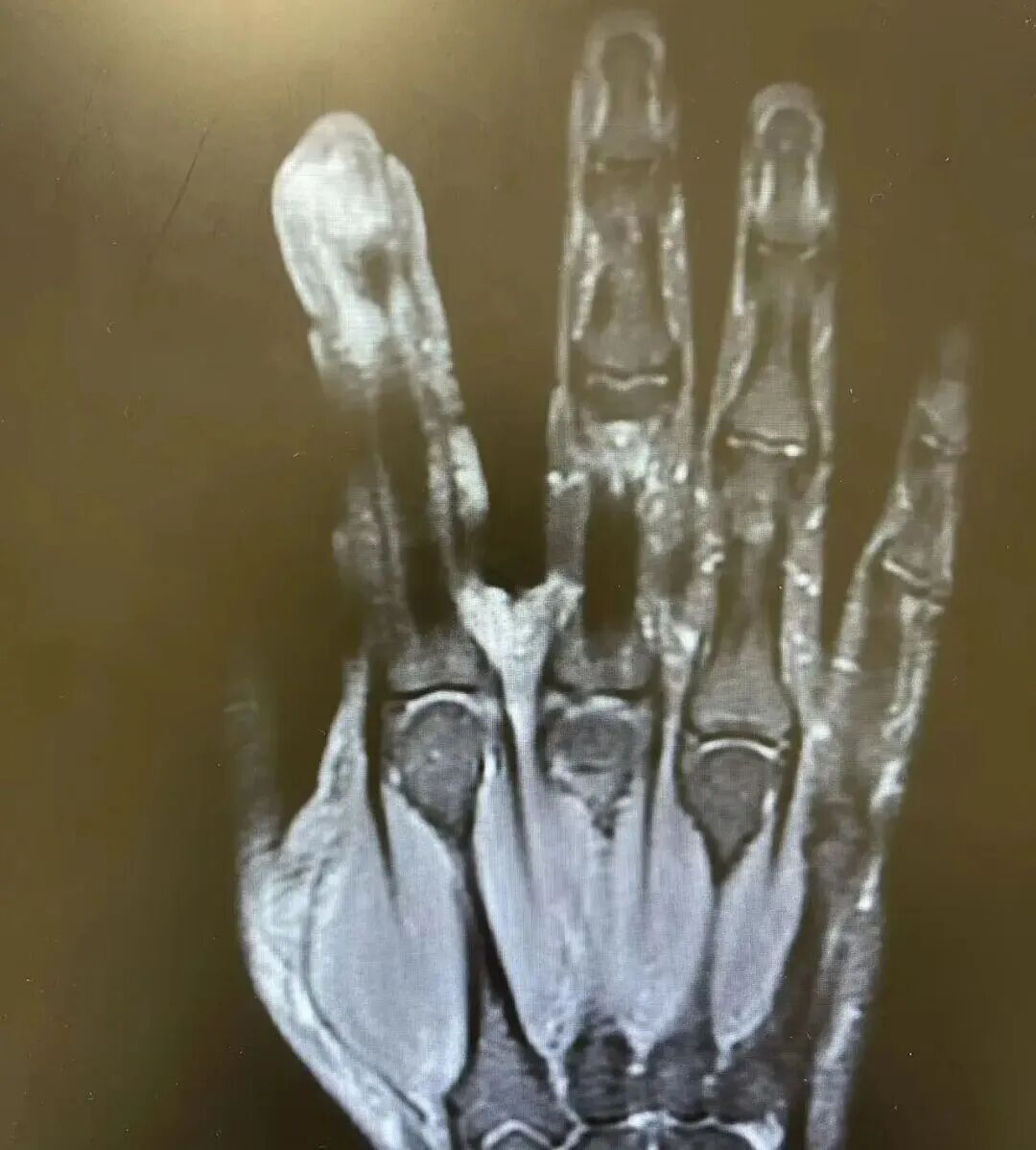 不要拔,很多人忍不住!男子不慎感染导致溃烂、刮骨疗毒 不要拔,很多人忍不住!男子不慎感染导致溃烂、刮骨疗毒