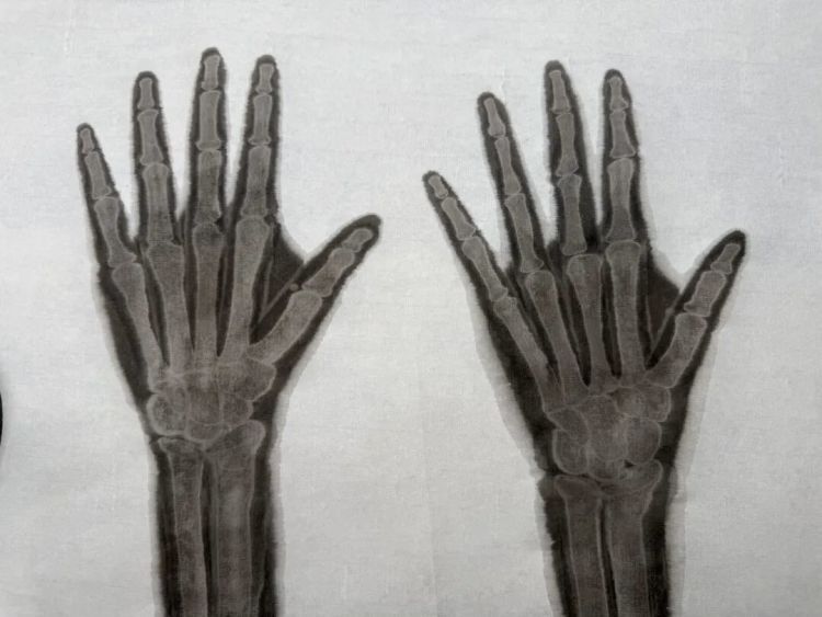 学医和学画的都惊呆了!医生手绘X光片“走红” 学医和学画的都惊呆了!医生手绘X光片“走红”