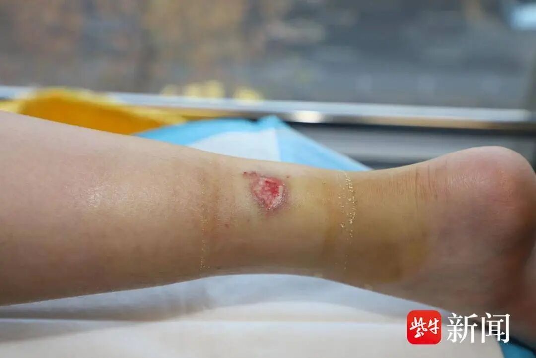 21岁女子连贴几晚暖宝宝入睡，致三度烫伤，专家：需手术清创