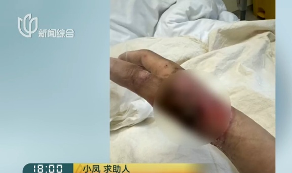 上海一美容院酒精突然爆炸！女子深度烧伤，巨额治疗费无着落…