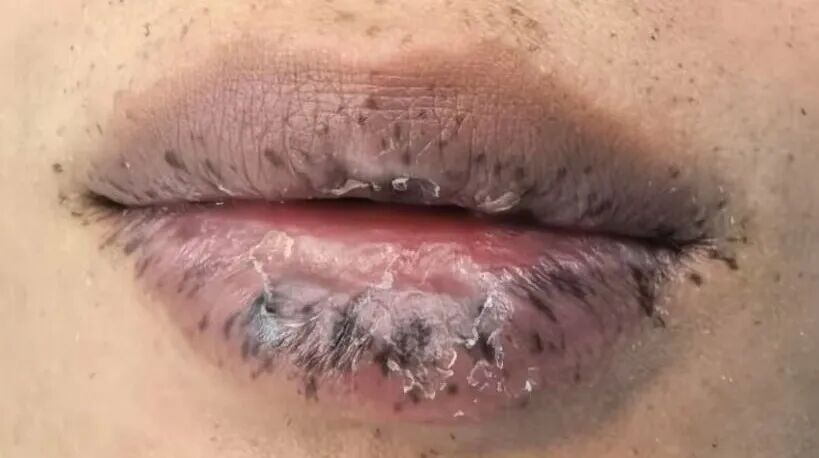 男子嘴唇周围长满黑点，竟是癌症来袭！还可能遗传
