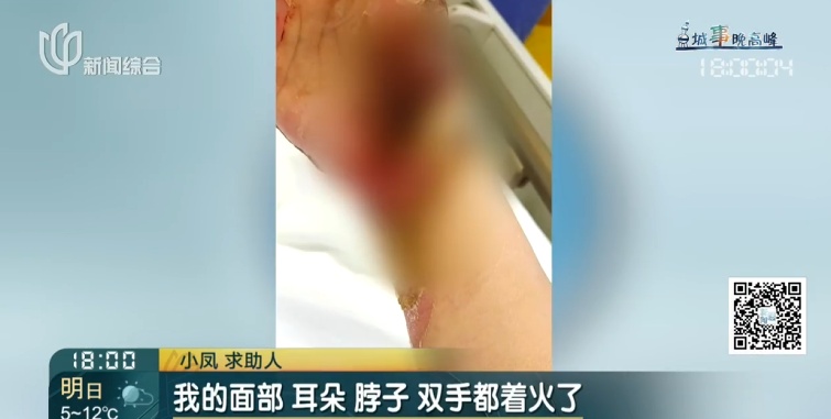 上海一美容院酒精突然爆炸！女子深度烧伤，巨额治疗费无着落…