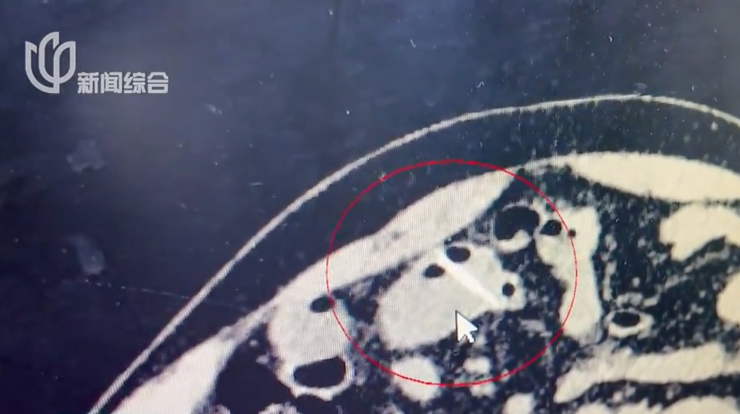 上海爷叔遭罪了！甲鱼骨头刺穿小肠！这种吃饭习惯请注意