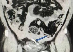 男子突然无法排尿！竟是膀胱“破”了！医生：这是连环效应