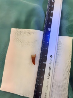 55岁阿姨咳嗽近4个月！这个坏习惯很多人都有，专家提醒