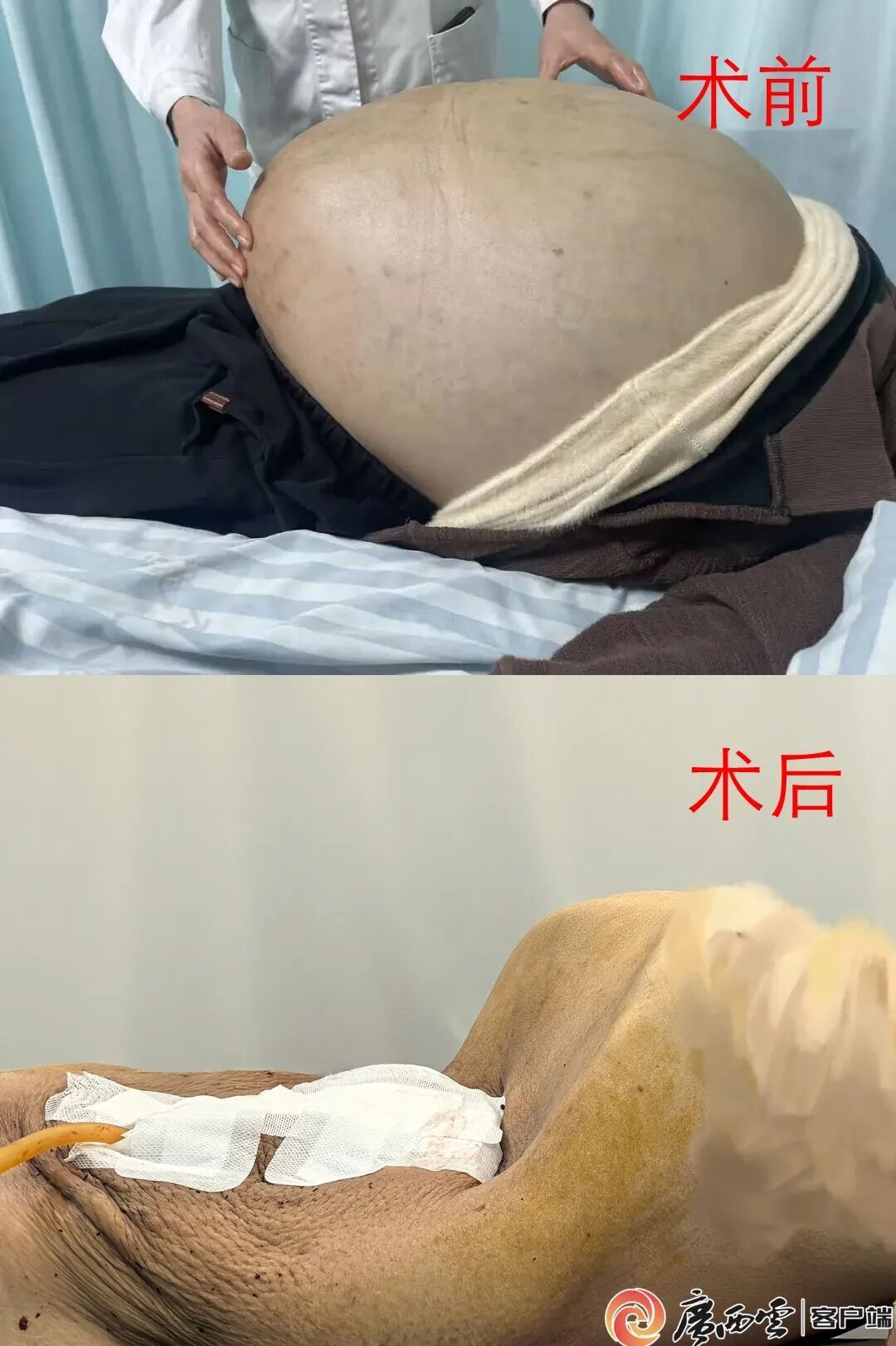 失忆流浪25年，女子腹中藏45公斤肿瘤！手术前她写下遗嘱：不要为难医生