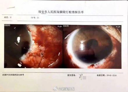 学校通报老师劝架被学生戳伤眼球:教师康复中,已处理涉事学生 学校通报老师劝架被学生戳伤眼球:教师康复中,已处理涉事学生