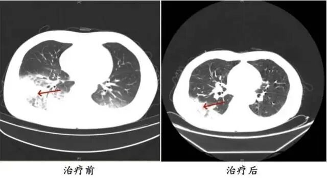 开了一晚上空调,78岁老人肺白了大半,没做这一步,先别开家里空调 开了一晚上空调,78岁老人肺白了大半,没做这一步,先别开家里空调