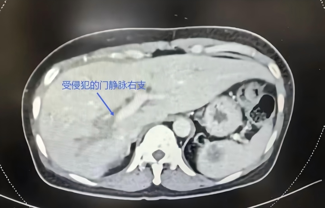 女子确诊“癌王”,全身发黄!整晚痒得睡不着,“恨不得拿钢丝球搓自己” 女子确诊“癌王”,全身发黄!整晚痒得睡不着,“恨不得拿钢丝球搓自己”