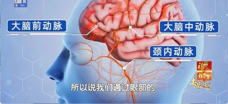 脑梗来临，眼睛先知？出现这3种改变，是脑梗的“最后通牒”！千万别拖