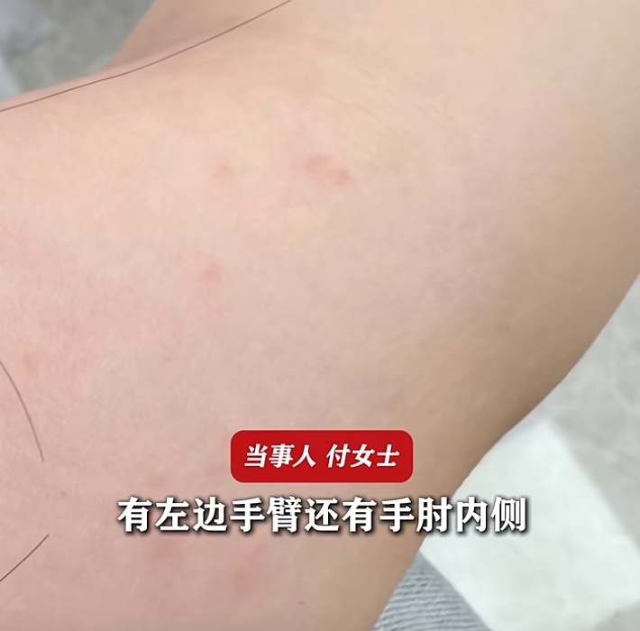 拍照时一个动作导致中毒过敏！网友搬出《甄嬛传》评论：安陵容说的话，有些还是要信的