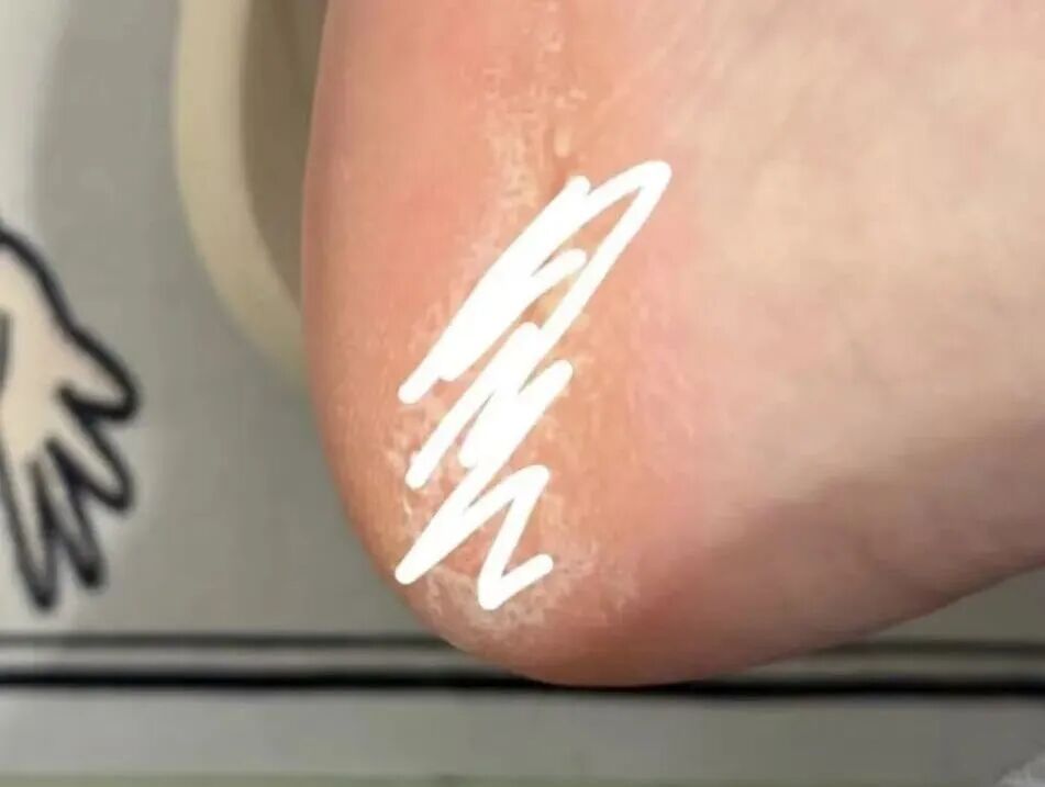 下雨天特别流行!很多人爱穿洞洞鞋,医生提醒→ 下雨天特别流行!很多人爱穿洞洞鞋,医生提醒→