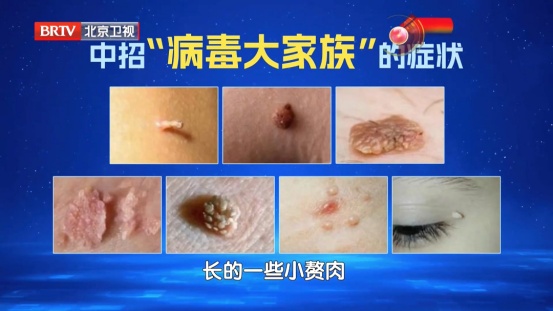 大部分女性都躲不过的病毒，反复感染易癌变，两个高危年龄段尤其要注意......