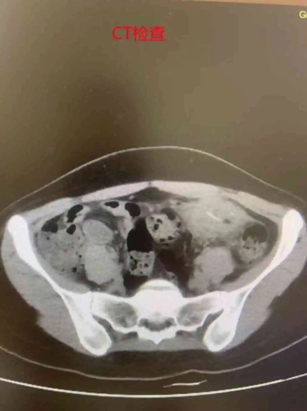 广州一女子腹腔中取出一次性筷子竹片，直呼“再也不敢边吃饭边看手机”……