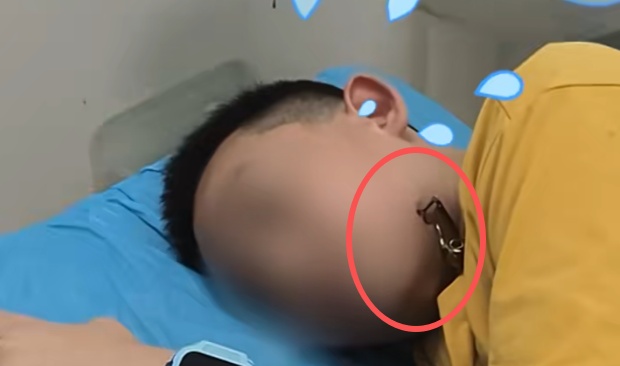 12岁男孩湖边玩耍被它一口“咬”脸！暑假尚未结束，家长们注意了！
