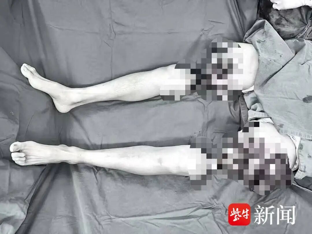 男子双大腿被绞断完全分离,经手术重新“接”回 男子双大腿被绞断完全分离,经手术重新“接”回