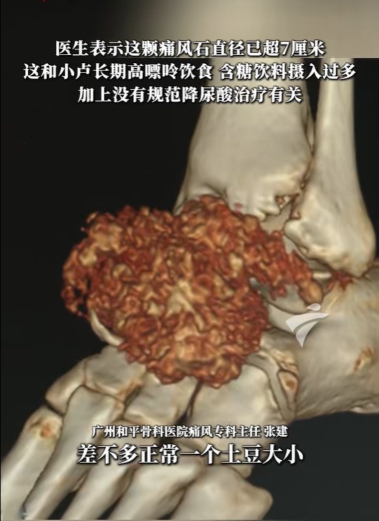 24岁男子脚上长出“土豆”，直径超过7厘米，走路都困难，医生紧急提醒