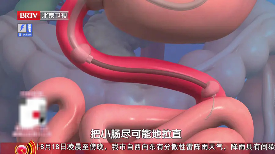 这种大便颜色,真的很危险,不是痔疮,身体出现3个变化,抓紧去医院 这种大便颜色,真的很危险,不是痔疮,身体出现3个变化,抓紧去医院